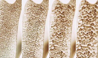 How to maintain strong bones and prevent osteoporosis using alternative solutions