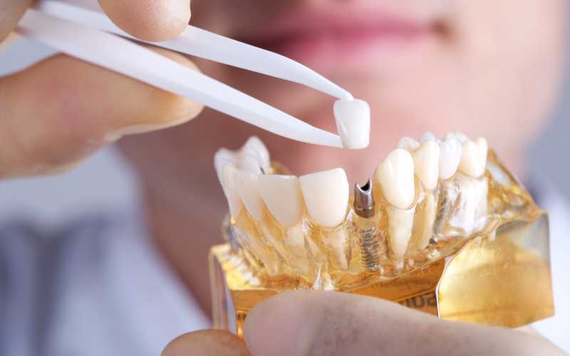 Key points to consider when choosing Dental implants vs Dentures